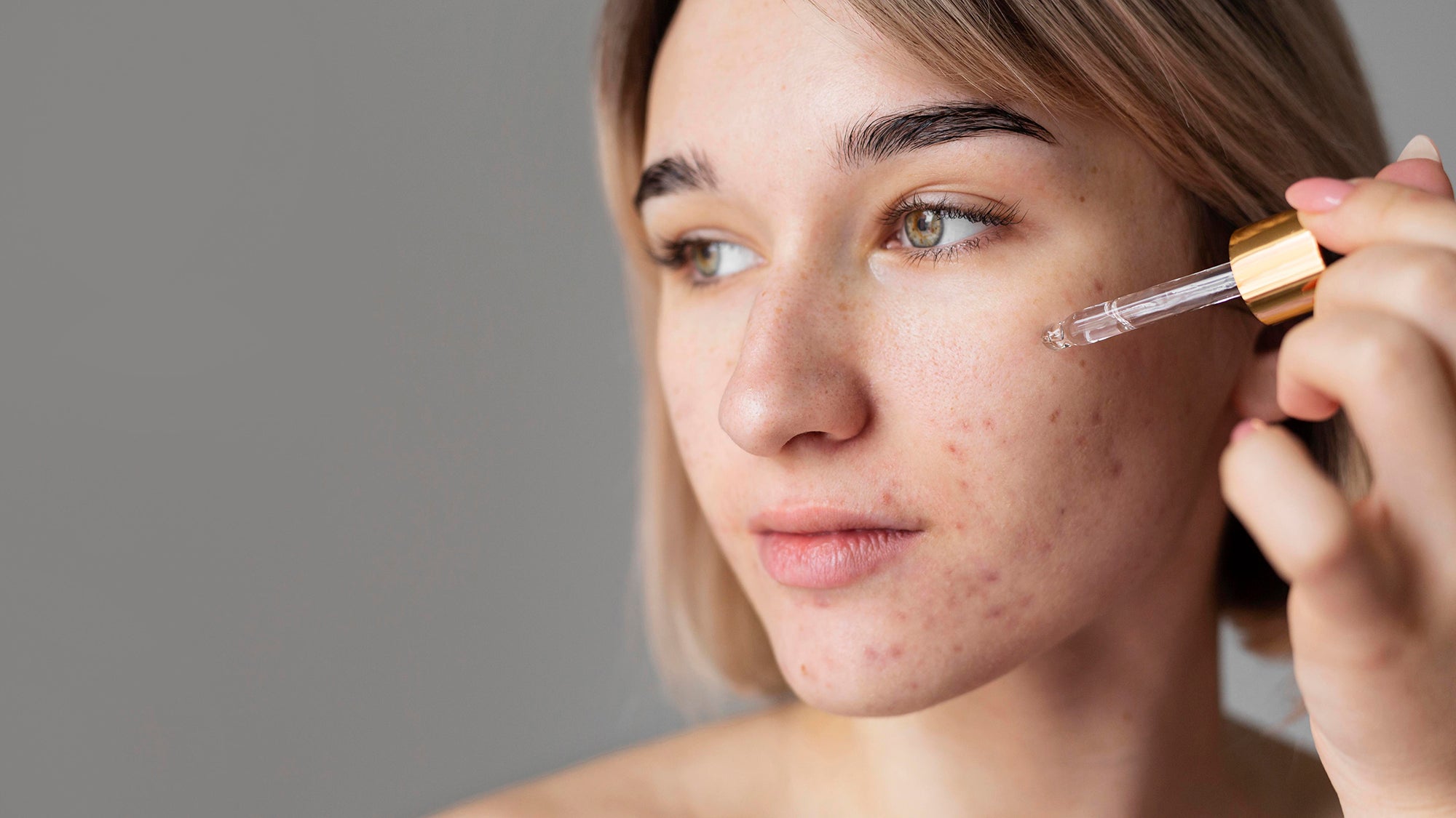 Part 2 Acne How and What to Address Skin & Bare It Esthetician