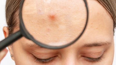Part 1 – Acne: What it is and What it Isn't